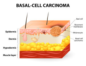skin cancer prevention and early detection