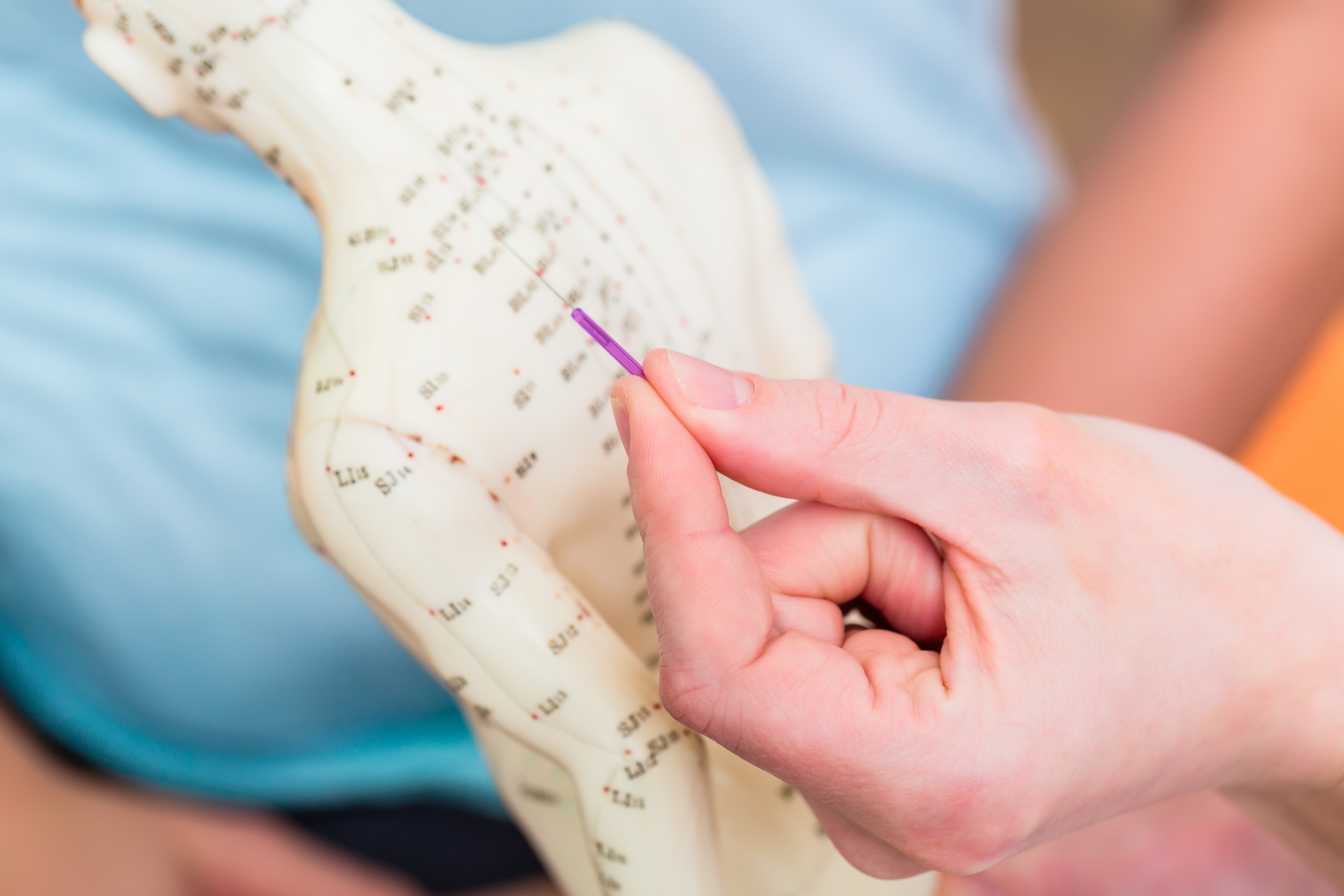 prescribing acupuncture for pain 2